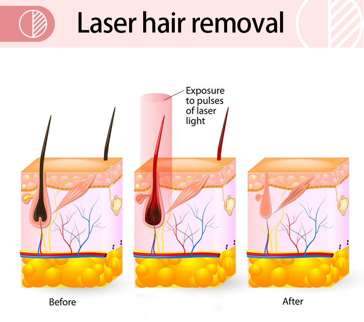 Professional Technical 808nm Hair Removal Diode Laser Beauty Machine