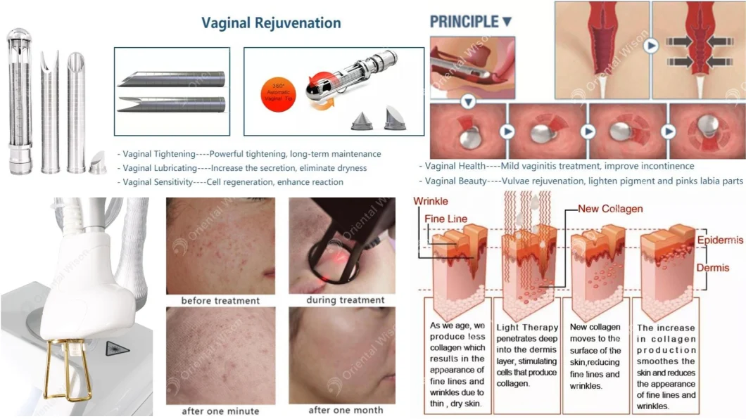 Professional Surgical CO2 Fractional Laser Skin Resurface /Scar Remove Beauty Machine /Vertical CO2 Treatment Vaginal Tightening CO2 Laser Beauty Machine Erbium